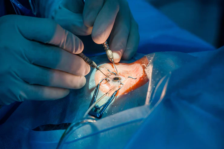 cornea transplant image
